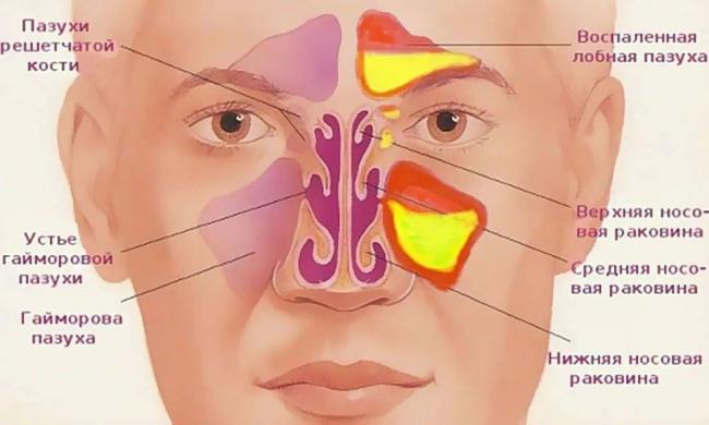 Лечение гайморита без антибиотиков в домашних условиях у взрослых и детей