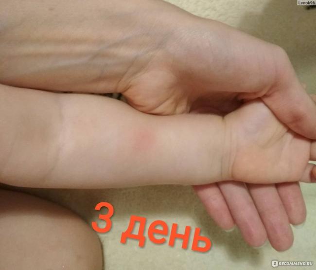 Возможные побочные действия и реакции на манту