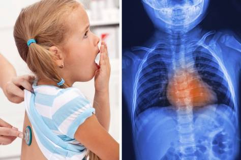 Лечение бронхита у детей: эффективные народные средства