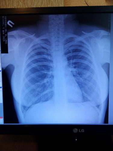 Сколько может держаться температура после лечения очаговой пневмонии? - вопрос пульмонологу - 03 онлайн