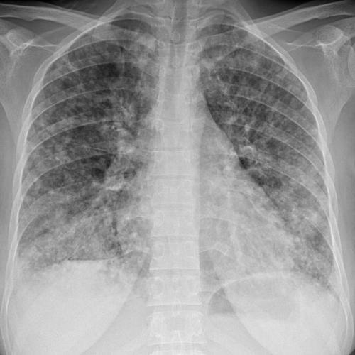 Пэт/кт очаговое образование на легком