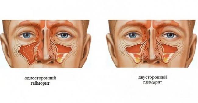 Лечение гнойного гайморита в домашних условиях