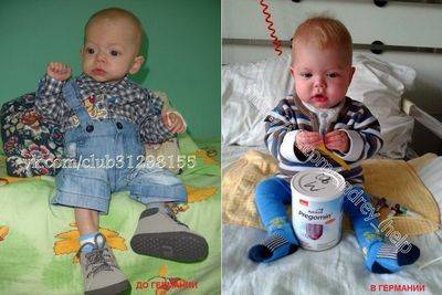 Сколько может держаться температура после лечения очаговой пневмонии?