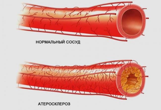 Рекомендации врачей, как правильно колоть диклофенак
