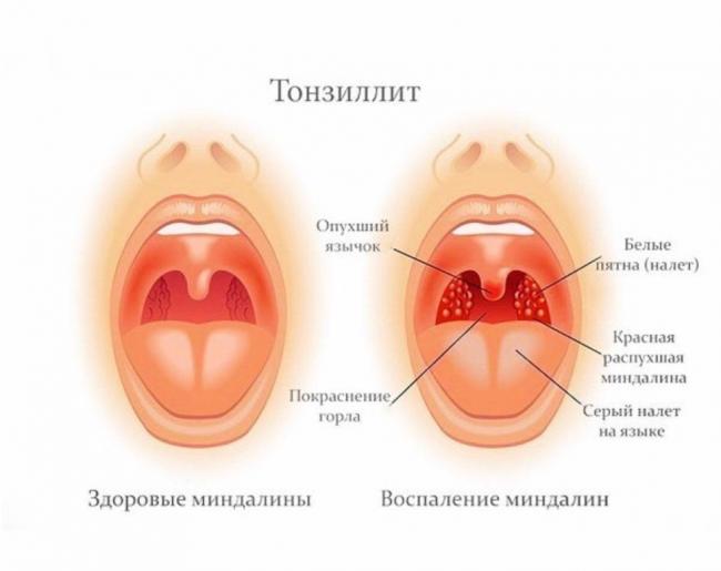 Аэрозоли для горла при гриппе
