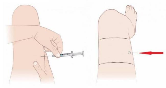 Рекомендации врачей, как правильно колоть диклофенак