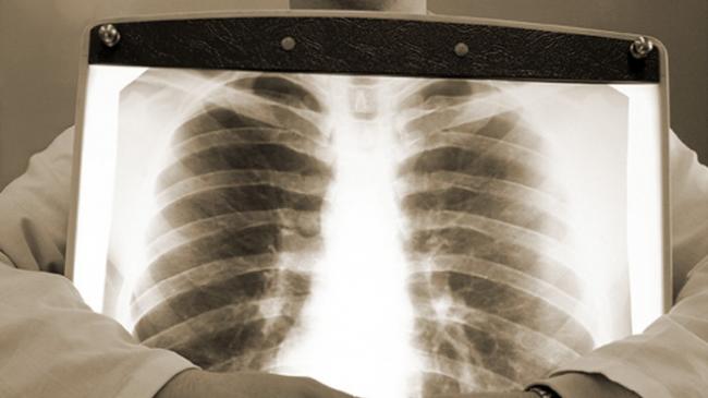 Какими симптомами проявляется воспаление легких у детей?