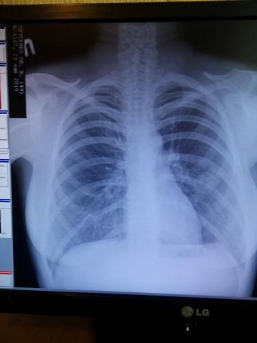 Сколько держится температура при пневмонии у взрослых и детей