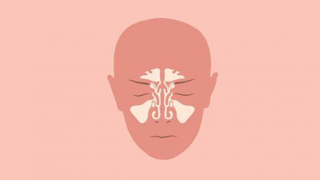 Как вылечить гайморит в домашних условиях у взрослых народными средствами?