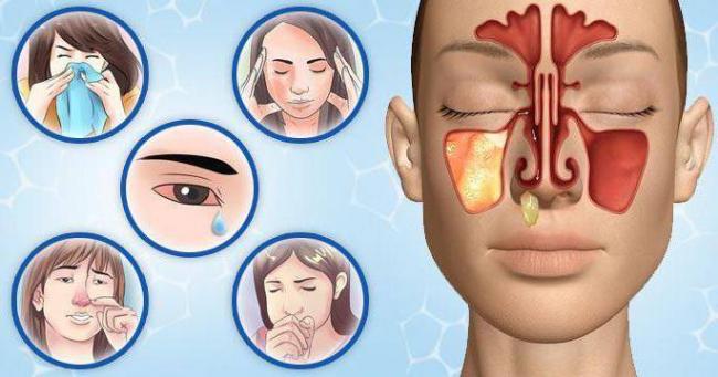 Можно ли вылечить гайморит без антибиотиков и как это сделать