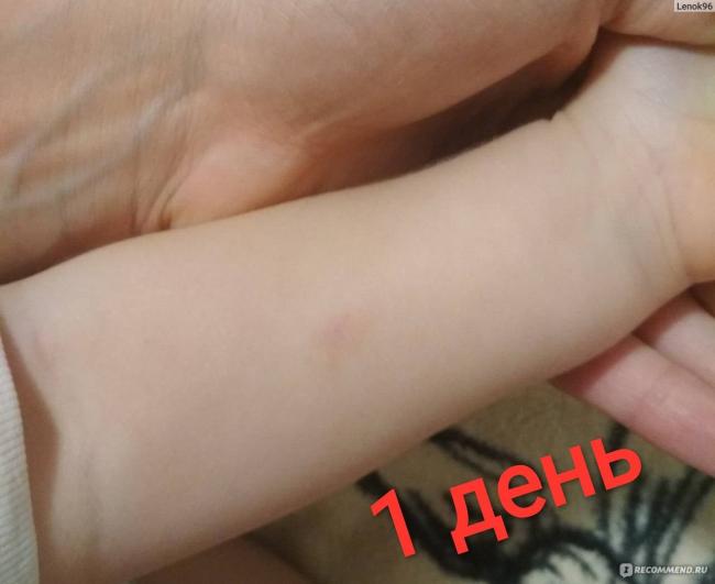 Как избежать температуры после манту у детей и взрослых?