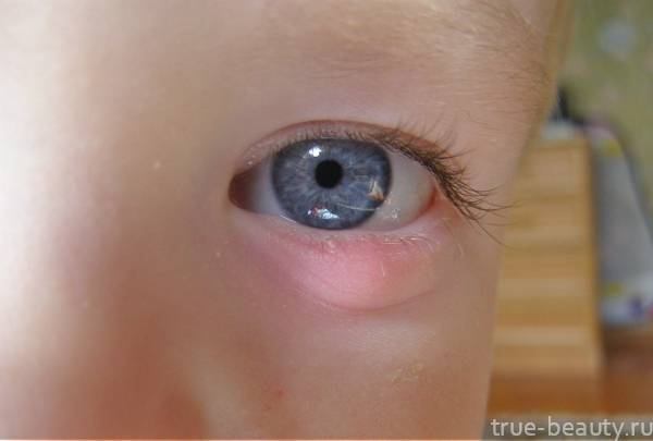 Ячмень под глазом - как и чем лечить, лечение, что делать, как вылечить