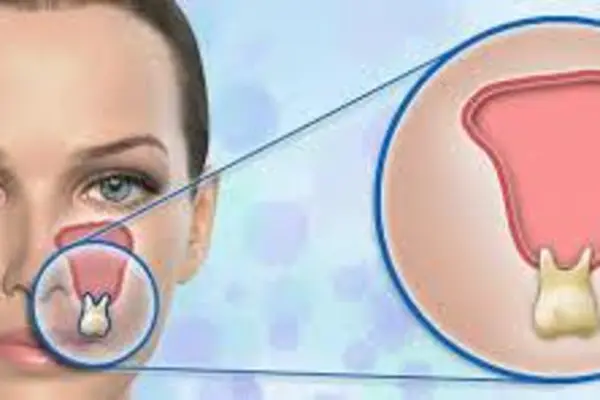 Лечение гайморита в домашних условиях у взрослых: антибиотики и народные средства