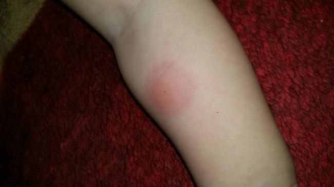 Как выглядит аллергия на манту у ребенка?