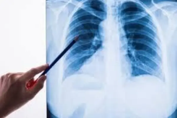 Пневмония у новорожденного ребенка: диагностика и лечение