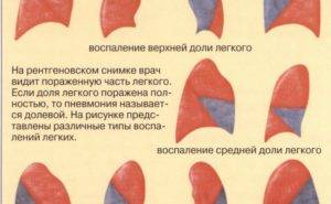 Температура 37.1 после левосторонней пневмонии