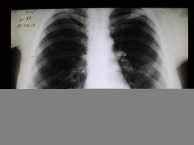 После лечения пневмонии температура 37: стоит ли сбивать?