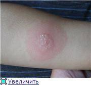 Опасна ли проба манту для детей: нормальные реакции и побочные эффекты прививки