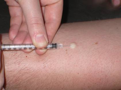 У ребенка поднялась температура после манту: норма или отклонение?