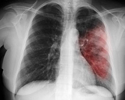 Прикорневая пневмония: симптомы и лечение у взрослых и детей, причины