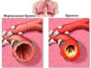 Причины появления крови в мокроте при бронхите, диагностика и методы лечения