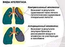 Ателектаз легких: причины, симптомы, лечение