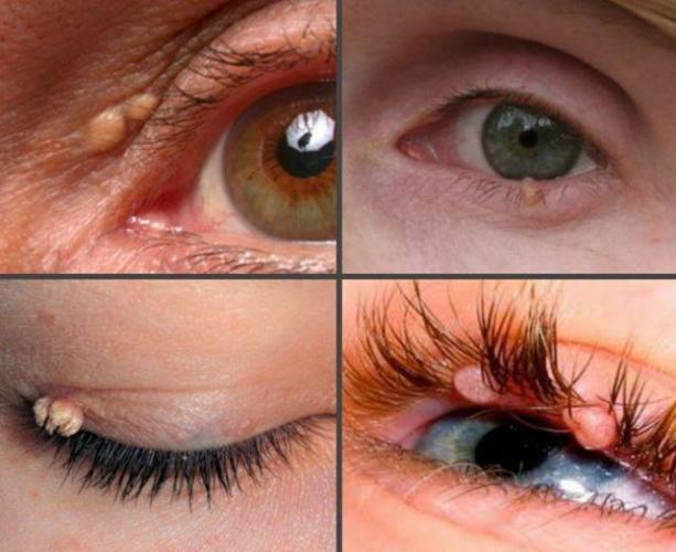 Папиллома на веке удаление народными средствами