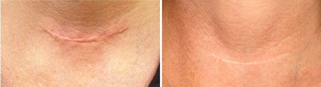 Дерматикс (мазь, гель)