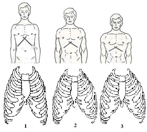 Килевидная грудная клетка: причины заболевания, основные симптомы, лечение и профилактика