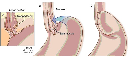 Ахалазия кардии