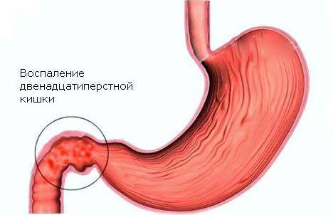 Бактерия хеликобактер пилори в желудке