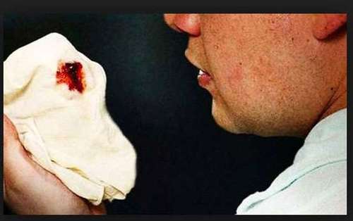 Мокрота с кровью при бронхите