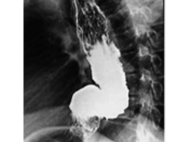 Недостаточность кардии желудка, ахалазия кардии пищевода – симптомы, причины