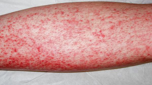 Норма эозинофилов в крови. причины повышения и понижения