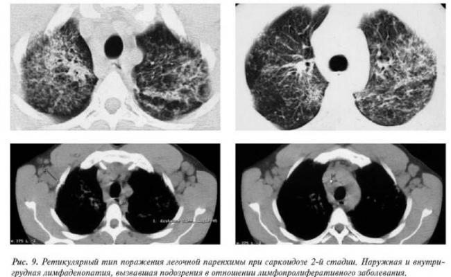 Пэт/кт очаговое образование на легком