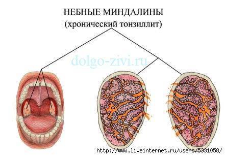 Лечение хронического тонзиллита дома, как лечить пробки в миндалинах в домашних условиях