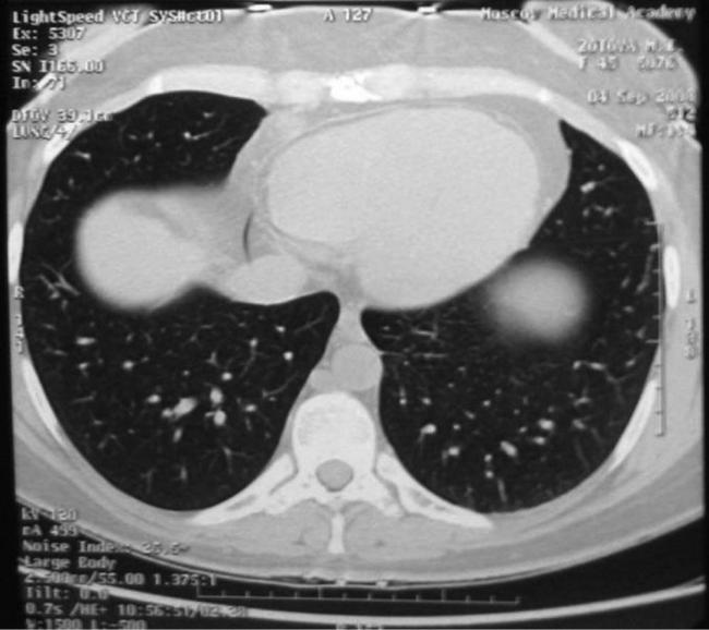 Пэт/кт очаговое образование на легком
