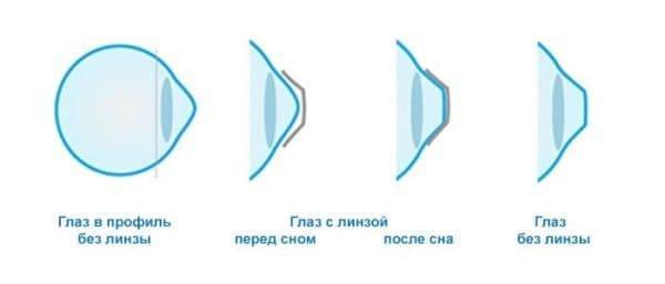 Линзы дышащие - какие самые лучшие для чувствительных глаз