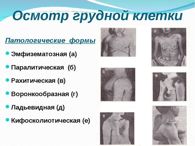 Деформация грудной клетки