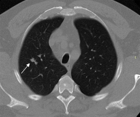 Томография в исследовании легкого