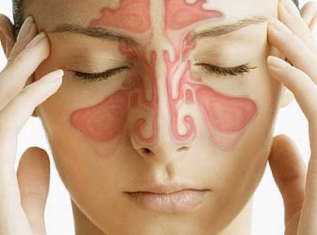 Гайморит: симптомы и лечение у взрослых