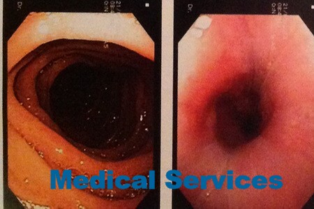 Недостаточность нижнего пищеводного сфинктера — ахалазия кардии