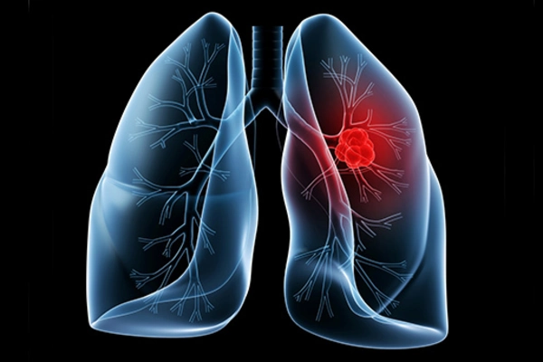 Чем отличается воспаление легких и пневмония