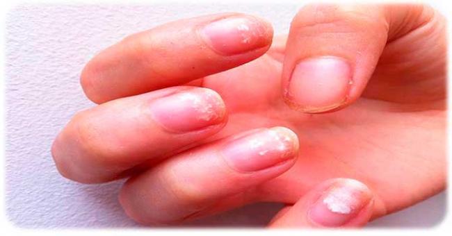 Почему слоятся ногти и что с этим делать?
