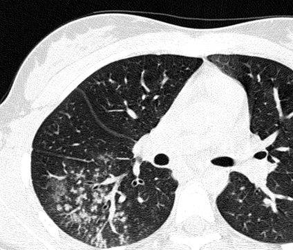 Когда назначают томографию легких