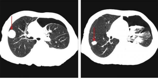 Очаги на кт легких