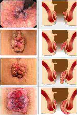 Геморрой и рак: как отличить на ранних стадиях патологии?