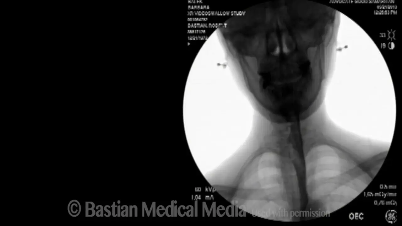 Пневмония новорожднных виды причины возникновения лечение и последствия
