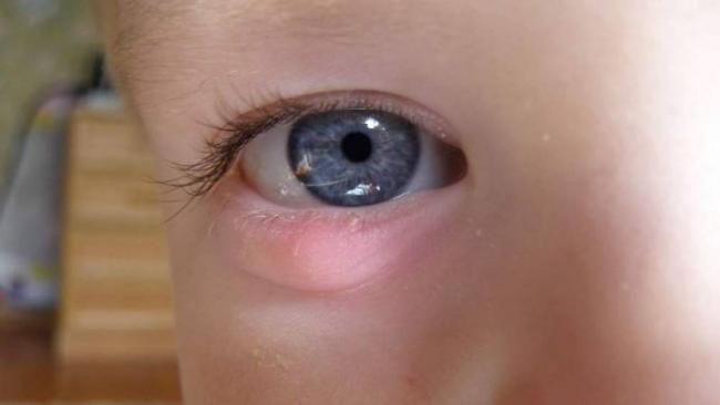 Бактериальный конъюнктивит глаз лечение у взрослых капли