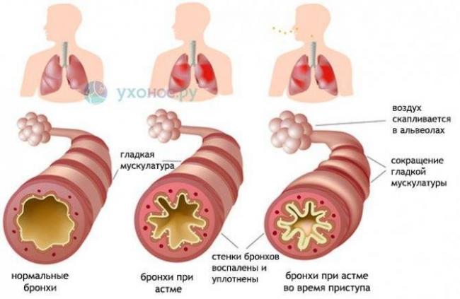 Слизь в носоглотке: скапливается и мешает дышать. как избавиться?